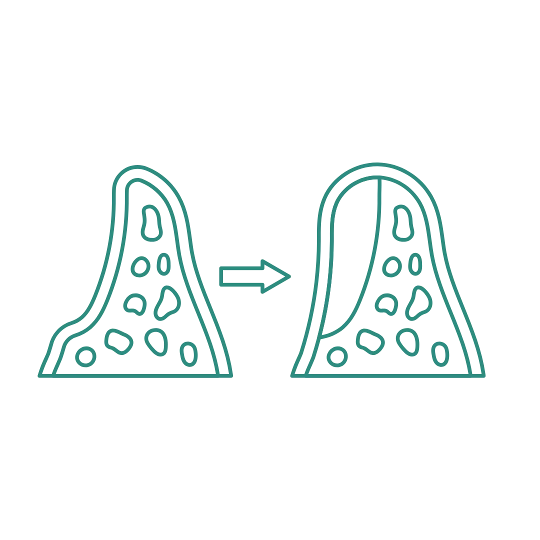 Bone Grafting
